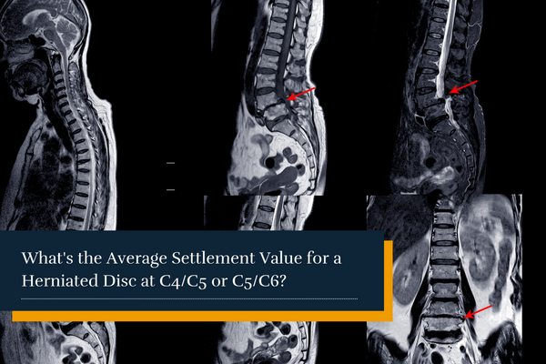 X-Ray of spinal cord compression at C4-5 and C5-6